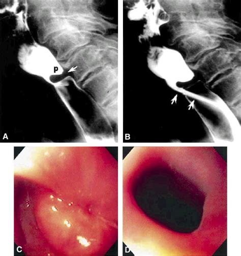 Endoscopic Images In Cricopharyngeal Dysfunction Gastrointestinal