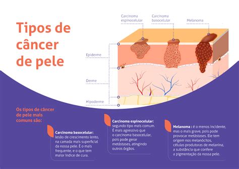 C Ncer De Pele Bp A Benefic Ncia Portuguesa De S O Paulo