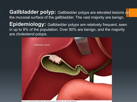 Gallbladder Ultrasound Basic Ppt