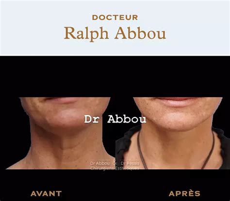 Neck Lift Paris Dr Ralph Abbou Cosmetic Surgeon