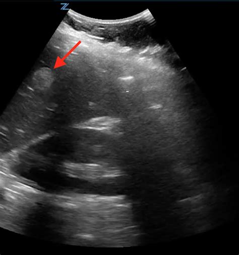 Liver Hemangioma Ultrasound