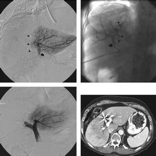 Transhepatic Ipsilateral Right Portal Vein Embolization Pve Extended