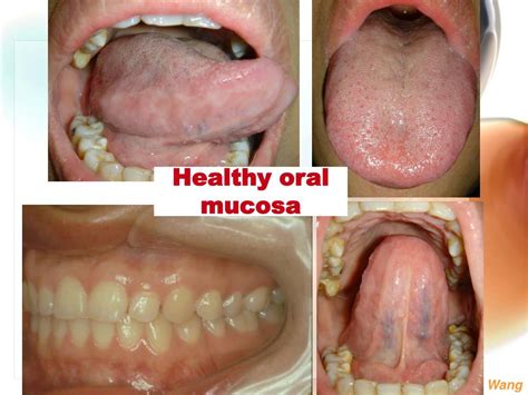 PPT - 1. White lesions of the oral mucosa 2. Solitary oral ulcer and fissures PowerPoint ...