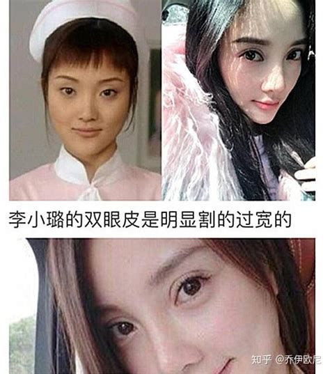 为什么割的双眼皮会显得假