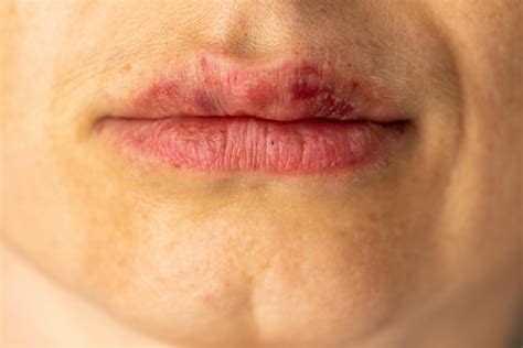 How To Dissolve Lip Filler Naturally At Home