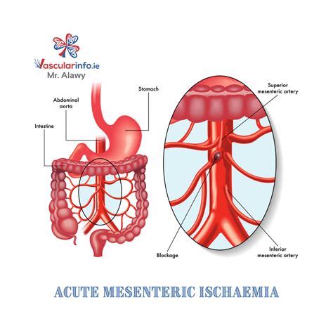 Mesenteric Ischemia Vascular Info