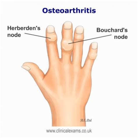 Osteoarthritis Flashcards Quizlet