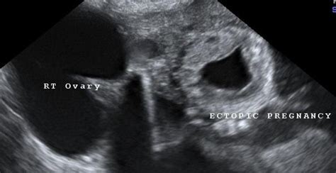 Intramural Ectopic Pregnancy A Case And Review Of The Literature European Journal Of