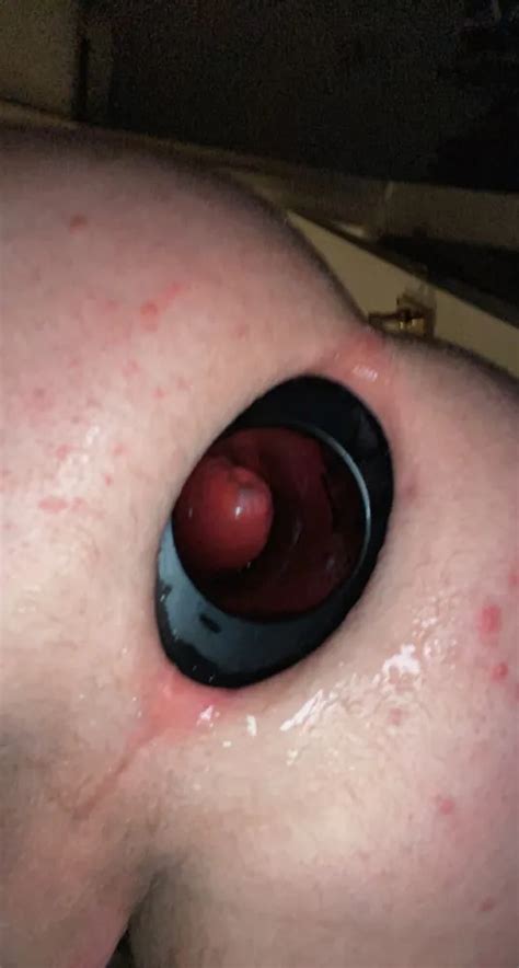 XXL MEO Anal Stretching Ring Nude Pics XHamster