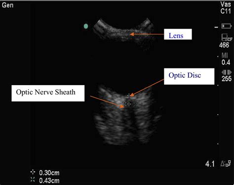 Bedside Sonographic Measurement Of Optic Nerve Sheath Diameter As A Predictor Of Increased