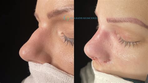 Removing A Dorsal Hump With Rhinoplasty Surgery Nose Aesthetics