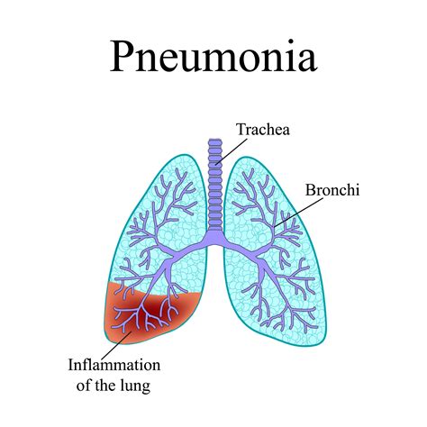 Pneumonia Types