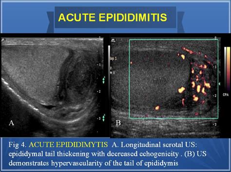 Figure 4 from Sonographic findings of epididymal masses | Semantic Scholar