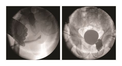 Combined Retrograde Urethrography Left And Antegrade Download Scientific Diagram