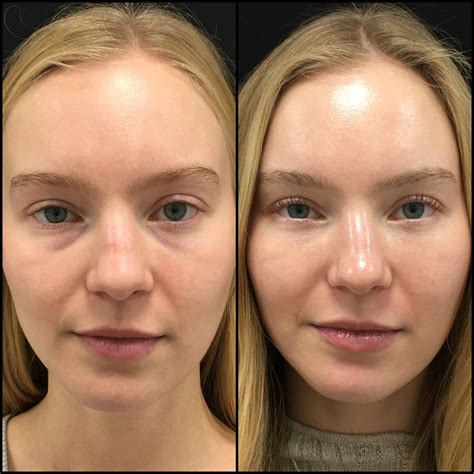 Lower Blepharoplasty Before After Photos Flora Levin Md