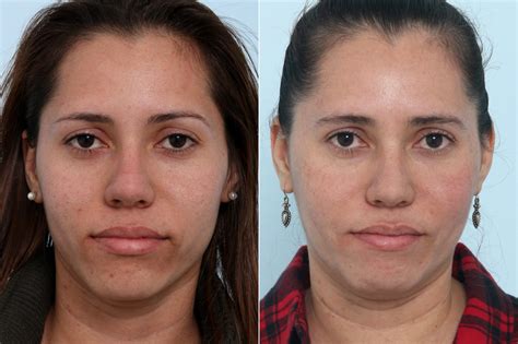 Solve Skin Pigmentation With Fraxel Laser Houston Tx