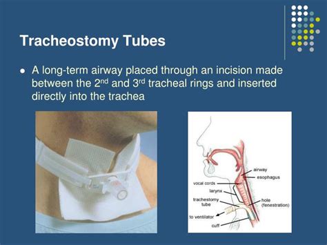 Ppt Airway Management Part Iii Powerpoint Presentation Id