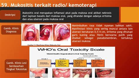 Penjelasan 95 Jenis Penyakit Mulut Part 3 Youtube