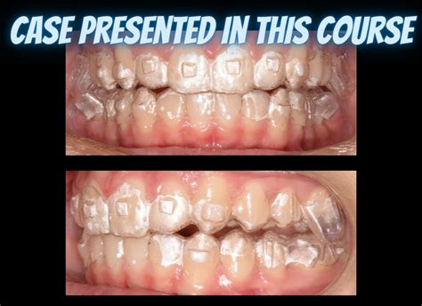 Class Ii Treatments With Clear Aligners The Clear Institute