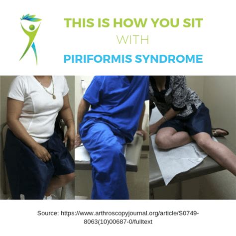 Frustrated? Piriformis Syndrome Treatment That Works When Your Pain Has ...