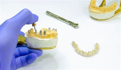 La Osteointegraci N En Implantes Dentales En Gij N Clinica Dental