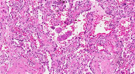 Lung Instance Segmentation Dataset By Jim