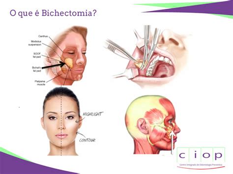 Bichectomia