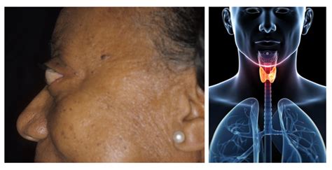 Graves Disease A Common Treatable Thyroid Disorder Crutchfield