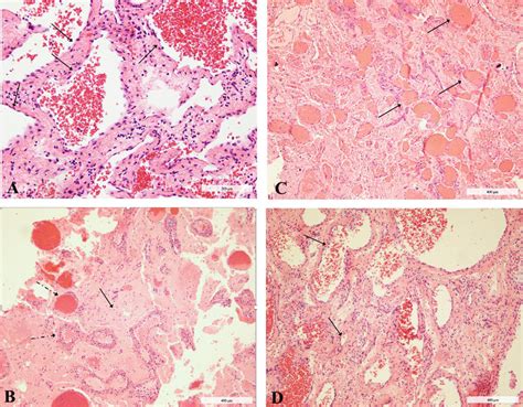 Light Microscopy Hematoxylin And Eosin Hande Stains Of The Lesion