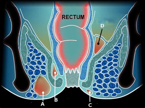 Perirectal Abscess Statpearls Ncbi Bookshelf Free Hot Nude Porn Pic