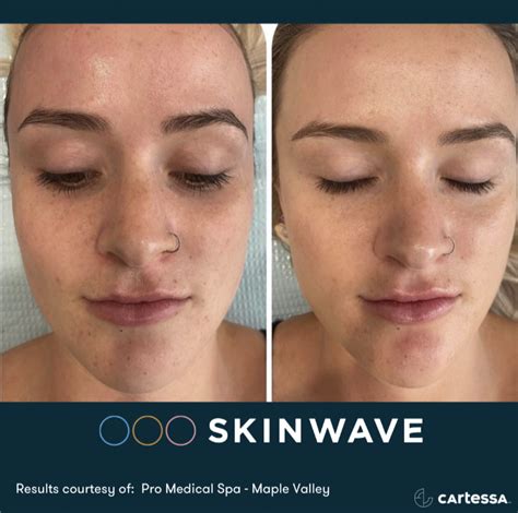 SKINWAVE HYDROFACIAL Contemporary Health Center