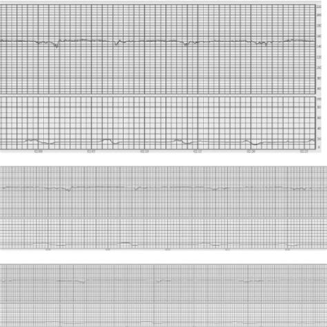 Pdf Figo Consensus Guidelines On Intrapartum Fetal Monitoring Cardiotocography