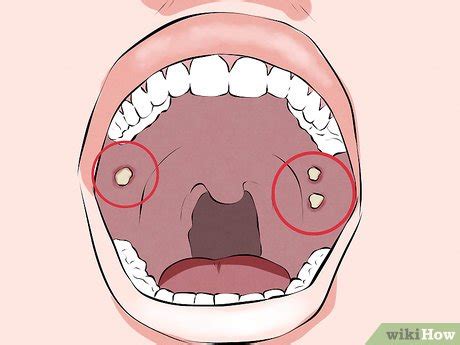 How to Recognize Signs of Oral Cancer: 11 Steps (with Pictures)