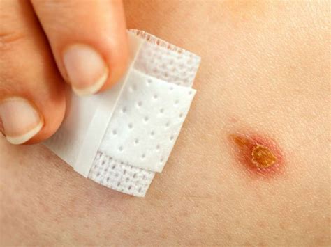 Scientists Design Smart Wound Healing Technique Wound Healing Diabetic Wounds Calamine Lotion