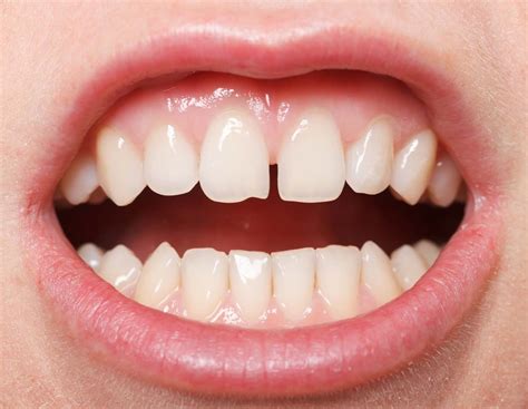 I Denti Del Sorriso Caratteristiche E Problematiche