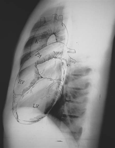 Lateral Chest X Ray Labeled