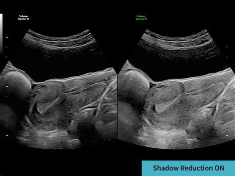 Voluson Signature 20 For Women S Health Ultrasound Ge Healthcare