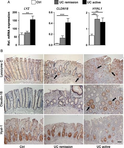 Epithelial Cells From Involved Colonic UC Tissue Share A Panel Of