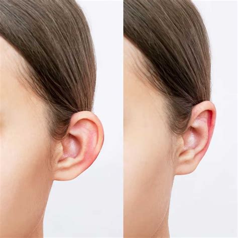 What Is Otoplasty Ear Pinning Surgery Magic Touch Turkey