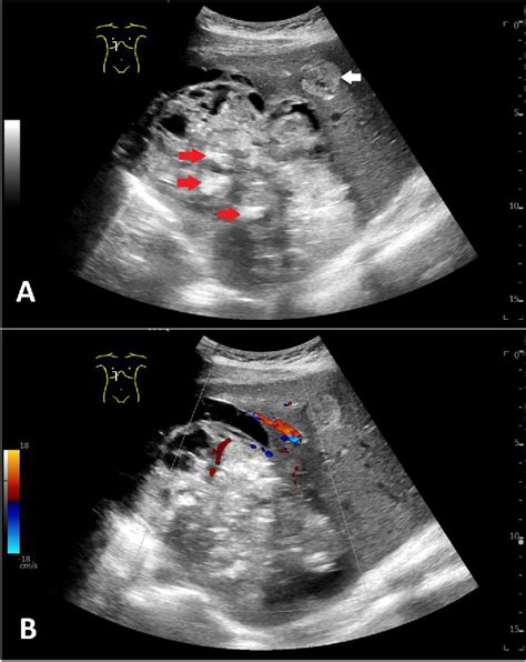 Figure 1 From Primary Immature Teratoma Of The Liver In An Adult Case