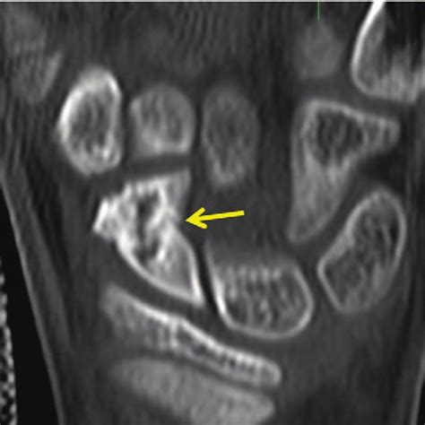 Computed Tomographic Scan Day 20 Pathologic Fracture Of The Scaphoid