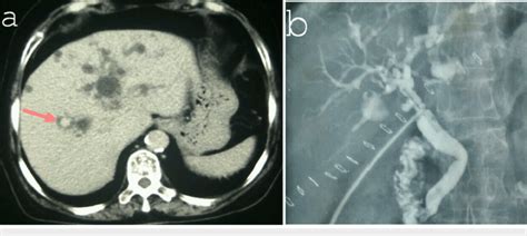 Contrast Ct A And T Tube Cholangiogram B Showing Type V Choledochal Download Scientific