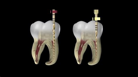 The WaveOne Gold File System With Dr Cliff Ruddle Dentsply Sirona