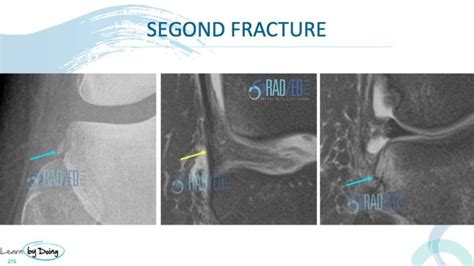 MRI SEGOND FRACTURE: WHAT TO LOOK FOR - Radedasia