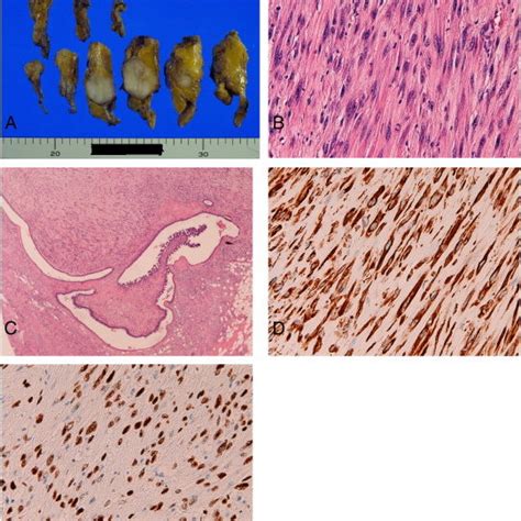 Findings Of The Third Tumor A Gross Cut Features B High Power View