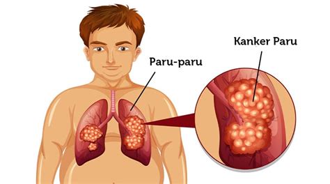 Kanker Paru Paru Newstempo