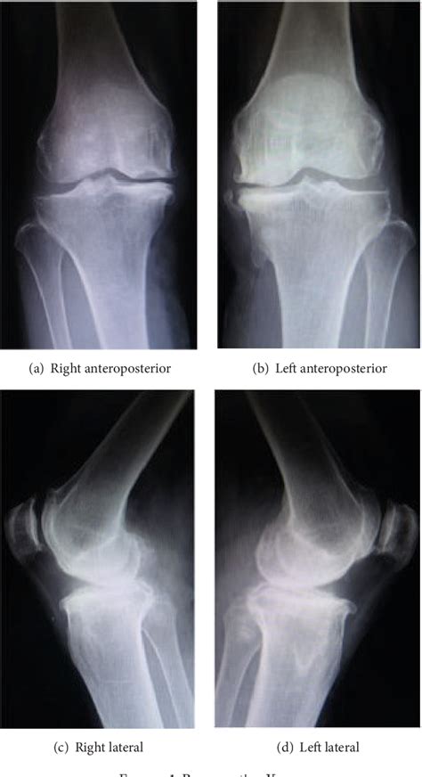 Figure From Gait Analysis Of Conventional Total Knee Arthroplasty And