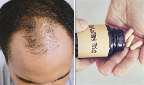 Hair Loss Treatment Vitamin B12 Supplementation Could Stop Hair