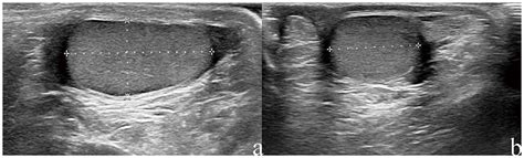 Measurement Of Testicle Length Width And Height By Ultrasound On A