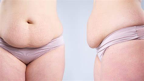 Titre Les Bienfaits Du Dlm Avant Une Abdominoplastie Mon Conseil